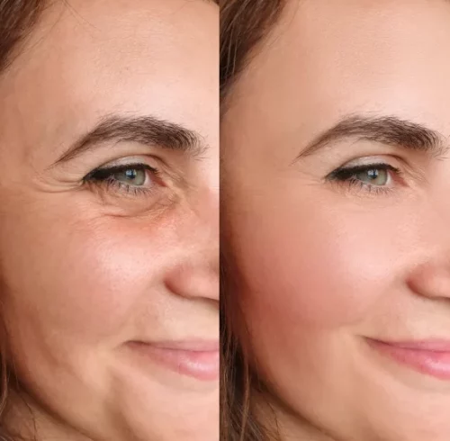 Botox-Behandlung