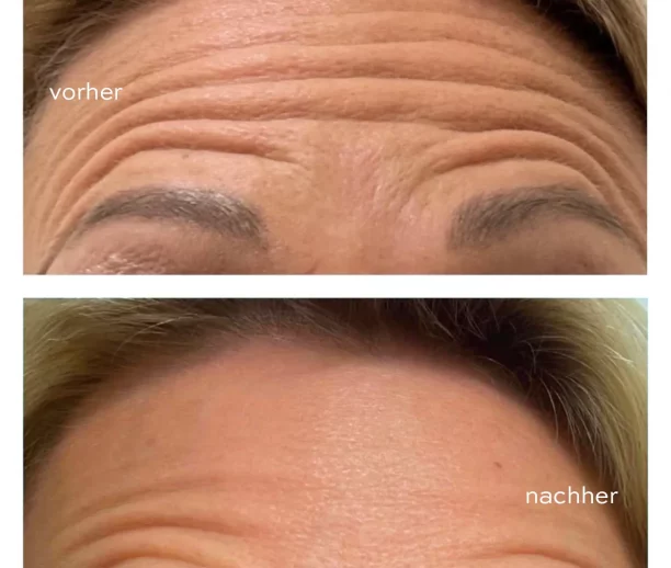 Filler - Before after