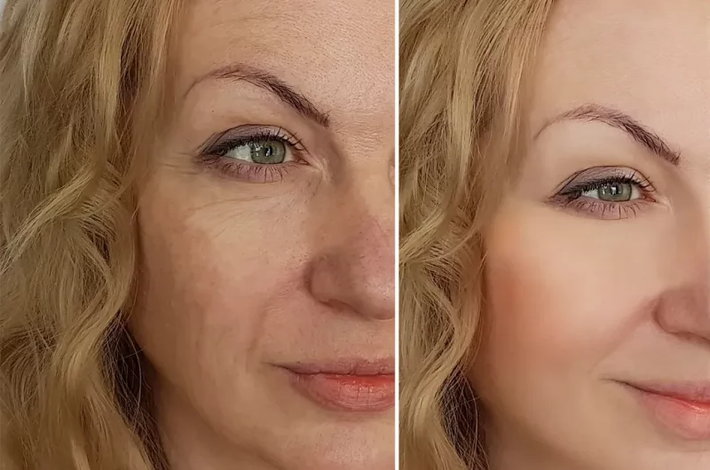 Botox-Behandlung vor und nach der Behandlung